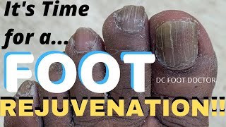 Foot Rejuvenation Reviving Worn Out Toenails In A Breast Cancer Survivor [upl. by Derron502]