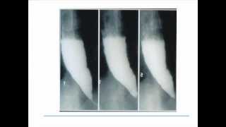 Esophageal Motility Disorders [upl. by Etnovaj727]