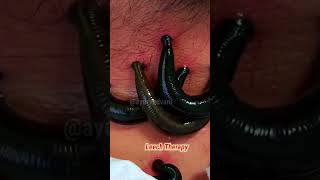 leeches cure  leeches therapy Ayurveda  panchkarma  shorts [upl. by Moshell]