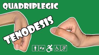 Tenodesis  Explained  Quadriplegic C5C6C7 [upl. by Nnylesor]