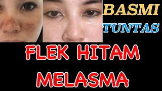 CARA MENGHILANGKAN MELASMA FLEK HITAM PADA WAJAH YANG SUDAH DALAM [upl. by Sitnik]