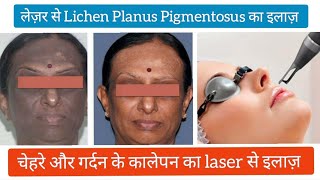 Laser से Lichen Planus Pigmentosus का इलाज़  lichen planus pigmentosus laser treatment lichenplanus [upl. by Annig642]