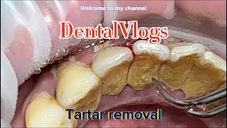 Tartar removal  Dentist [upl. by Annoif]