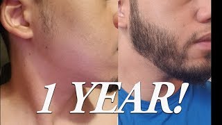 1 year of Minoxidil to grow a Beard BEARD TIMELINE [upl. by Nuahsyd]