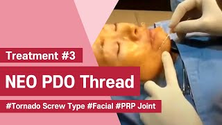 NeoGenesis Thread Series PDO Tornado Screw Type Facial Joint Procedure with PRP [upl. by Schilt]