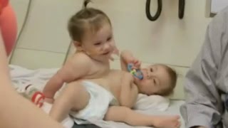 Conjoined Twins Successfully Separated [upl. by Ahsap]