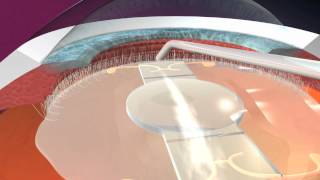 Dropless™ Cataract Surgery [upl. by Elisa]