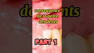 Consequence de la perte des dents PART 1 shorts fyp viralvideo [upl. by Byrle]