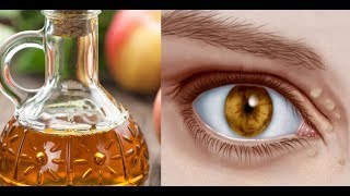 Natural Remedies to Cure Xanthelasma or Cholesterol Deposits Around the Eyes [upl. by Arabeila]