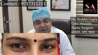 What is Xanthelasma Removal Treatment  Dr Shobhit Gupta Xanthelasma Laser Removal Before and After [upl. by Ansley]