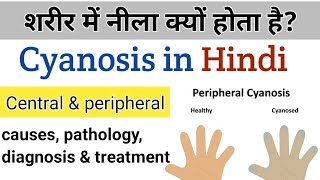 what is cyanosis  causes types amp treatment in Hindi [upl. by Dion]