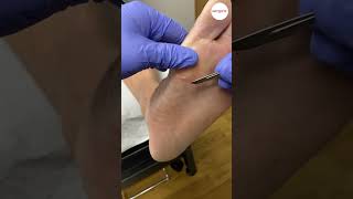 Thick Heel Callus Removal [upl. by Egroj]