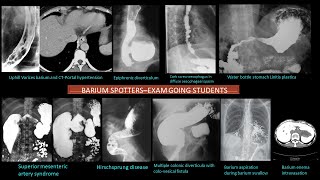 BARIUM SPOTTERS EXAM GOING STUDENTS [upl. by Deuno]