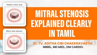 Mitral Stenosis Explained in Tamil [upl. by Mather42]