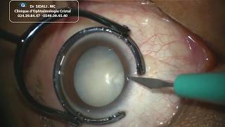 Chirurgie de la cataracte sans sutures par ultrasons  PHACOEMULSIFICATION [upl. by Leyes]