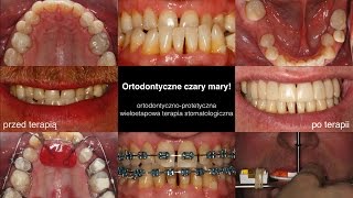 Ortodontycznoprotetyczna wieloetapowa terapia stomatologiczna [upl. by Hebbe318]