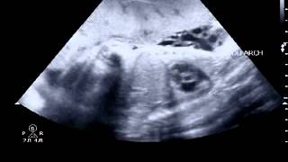 Fetal ductal arch combined ultrasound video [upl. by Anafetse]