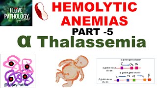 Hemolytic Anemias Part 5 Alpha Thalassemia Pathogenesis types Diagnosis amp Treatment [upl. by Tselec256]