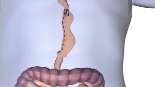 Esophagectomy Procedure Animation [upl. by Zetrom]