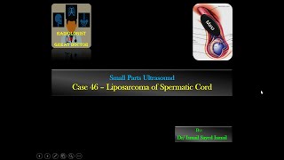 Ultrasound Case 46  Liposarcoma of Spermatic Cord [upl. by Naeerb877]