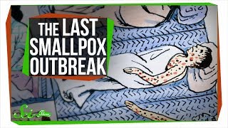 The Last Major Smallpox Outbreak in America [upl. by Button457]