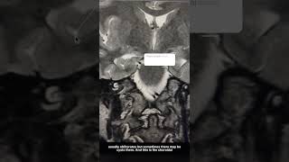 Hidden reason for epilepsyseizure Hippocampus anatomy amp disorder radiology mri seizures [upl. by Saundra86]