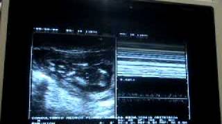 Miscarriage or spontaneous retained abortion 13 weeks [upl. by Diarmit]