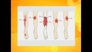 What causes heavy aching legs  Usapang Pangkalusugan [upl. by Eusadnilem]