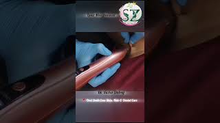 Laser mole removal treatment pain less process shortsfeed mole drrichadubey drtreatment [upl. by Guinna]