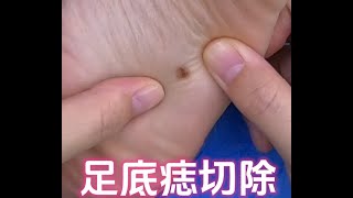 【手术实录】为什么足底色素痣需要切除？plasticsurgeon 高能 melanoma [upl. by Mraz]