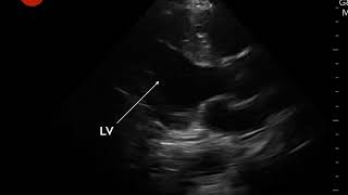 Video 6 Hyperdynamic LV contractility [upl. by Thilda]