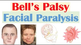 Bell’s Palsy Facial Paralysis  Causes Pathophysiology Signs amp Symptoms Diagnosis Treatment [upl. by Yelloh]