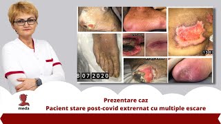 Prezentare caz  Pacient stare postcovid extrernat cu multiple escare  Promo medatalos nursery [upl. by Rolyak]