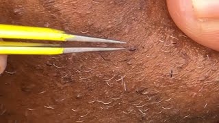 Tweezing chin hairs 25💛 [upl. by Venn]