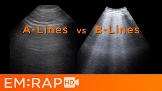 Ultrasound of Pulmonary Edema [upl. by Suedaht]