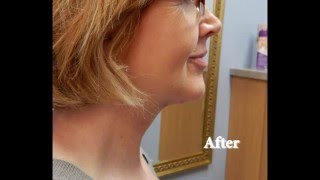 Learn about neck rejuvenation with platysmaplasty [upl. by Greenebaum676]