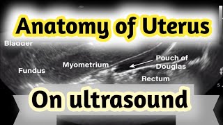 Sonographic Anatomy of UterusGyneacological ultrasound [upl. by Edrea]