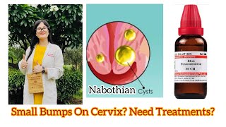 Nabothian Cyst Homeopathic MedicineCervical Cyst Homeopathic TreatmentBumps On Cervix DrRukmani [upl. by Elon]