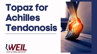 Topaz for Achilles Tendonosis  Weil Foot amp Ankle Institute [upl. by Tilly]