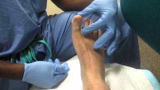 Hallux Block MWMC Podiatry [upl. by Crofton]