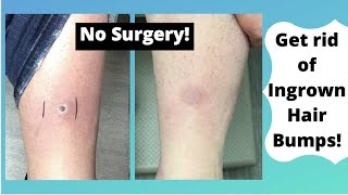 Dermatofibromas Removal – Get rid of hard scars [upl. by Eiknarf]