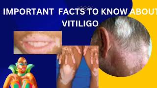 vitiligopart2diagnosis and latest treatment about opzelura creamskinhealthvitality5959 [upl. by Simons886]