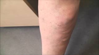 Severe superficial thrombophlebitis before and 48 hours after treatment [upl. by Rebme]