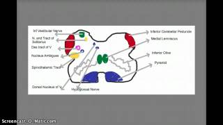 Lateral Medullary Syndrome [upl. by Orlov]