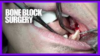 Bone Block surgery Oral [upl. by Carlynne]