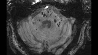 Multiple Cavernoma Syndrome [upl. by Remus]