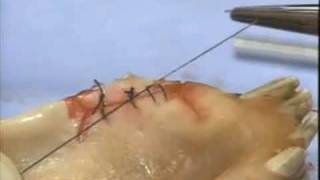 Introduction to Periodontal Surgery Techniques Initial Incisions and Suturing [upl. by Assele]