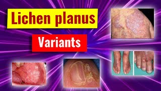 Clinical variants of lichen planus [upl. by Polak]