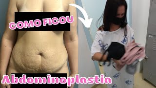 MOSTREI MEU CORPO COM 3 MESES DE ABDOMINOPLASTIA EM ÂNCORA E LIPOASPIRAÇÃO [upl. by Amhser]