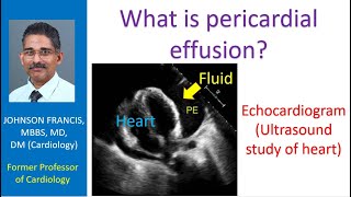 What is pericardial effusion [upl. by Leahsim]